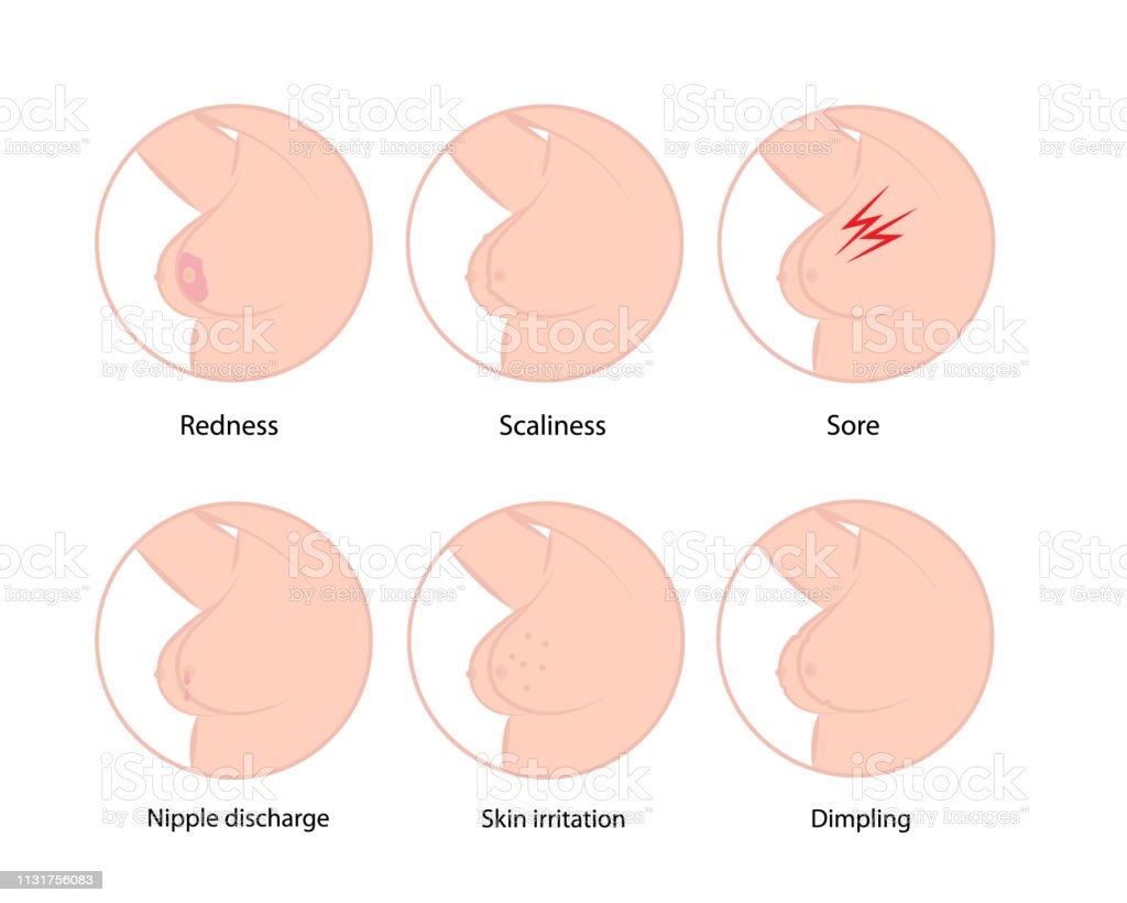 Early Symptoms Of Breast Cancer Stock Illustration ...