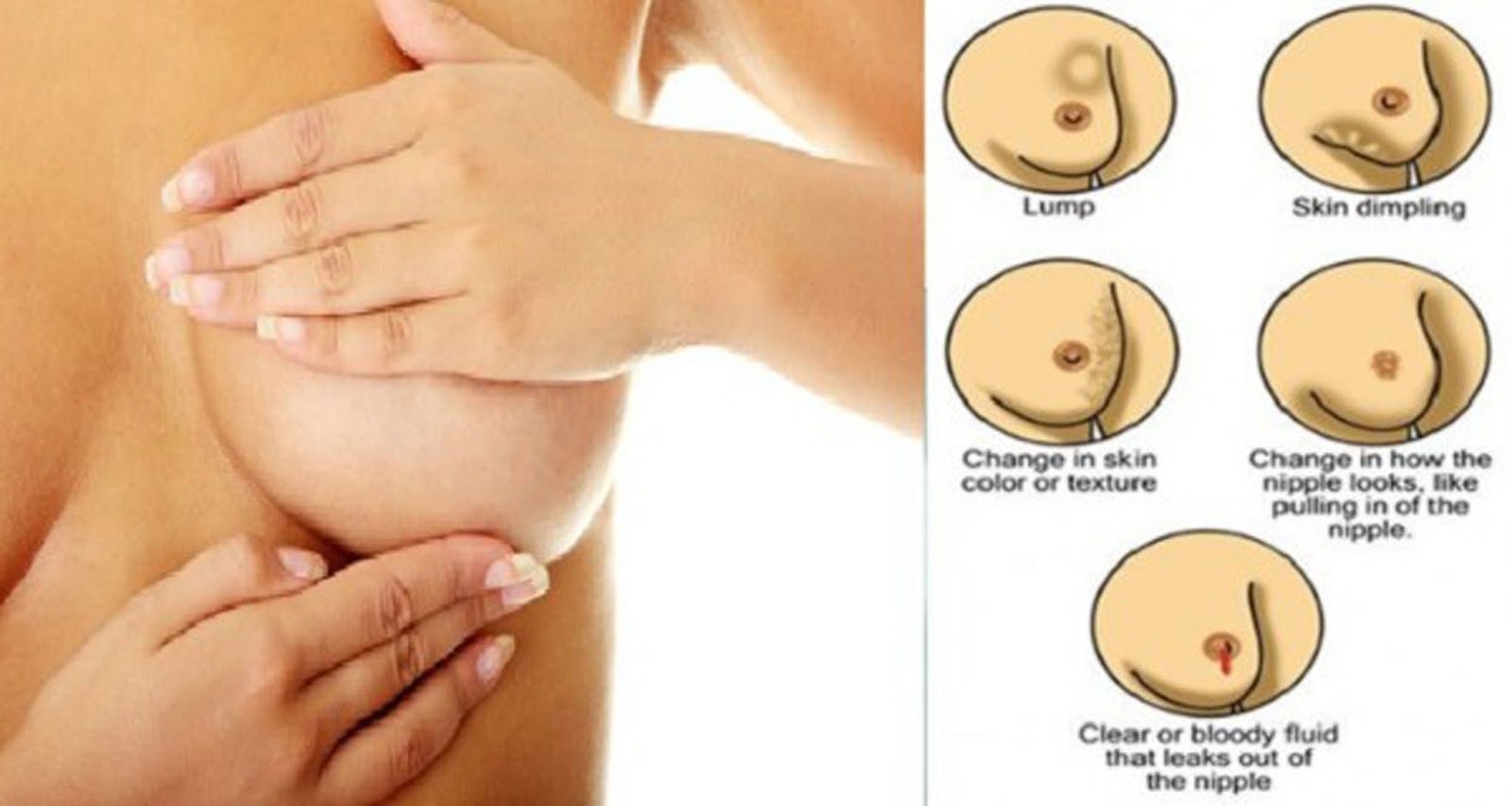 EARLY WARNING SIGNS OF BREAST CANCER NO ONE TALKS ABOUT ...