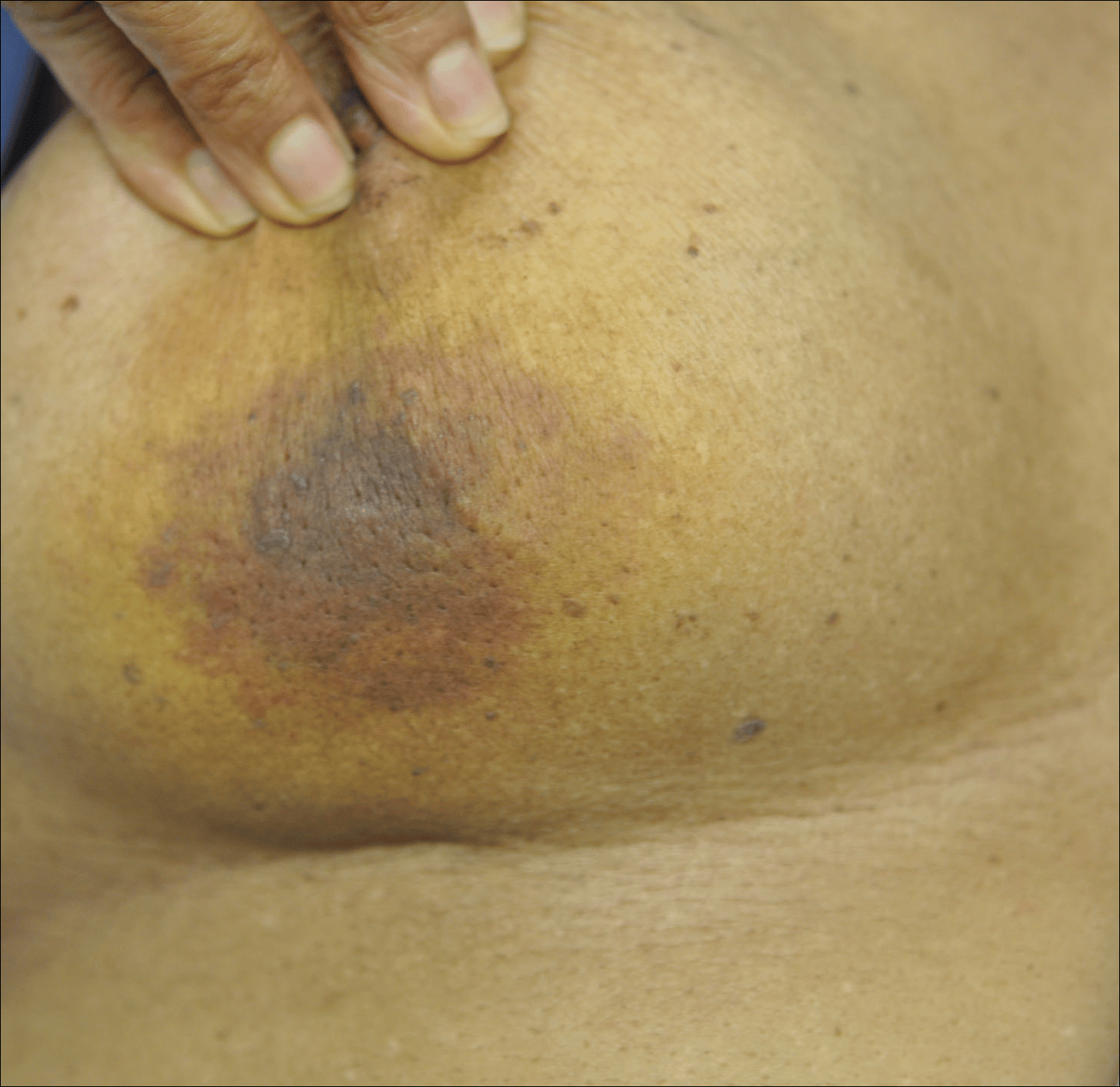 Enlarging Breast Lesion