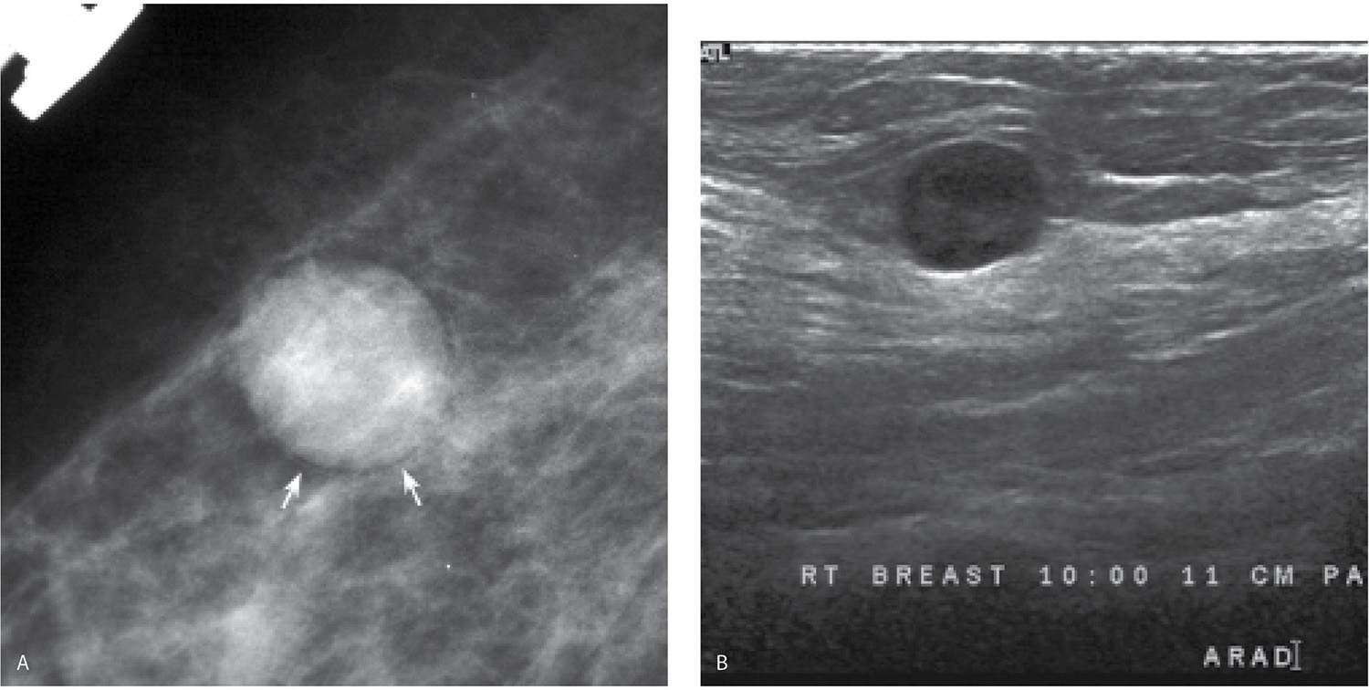 Evaluation and Imaging Features of Benign Breast Masses