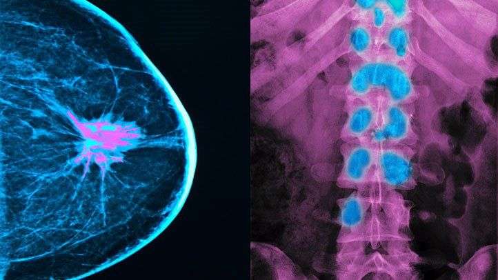 Everything You Need to Know About Breast Cancer Metastasis in Bones ...