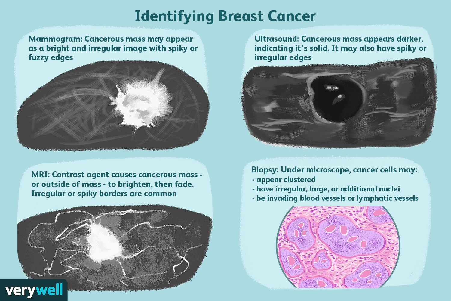 Fibroadenoma Breast Ultrasound Cancer Vs Benign