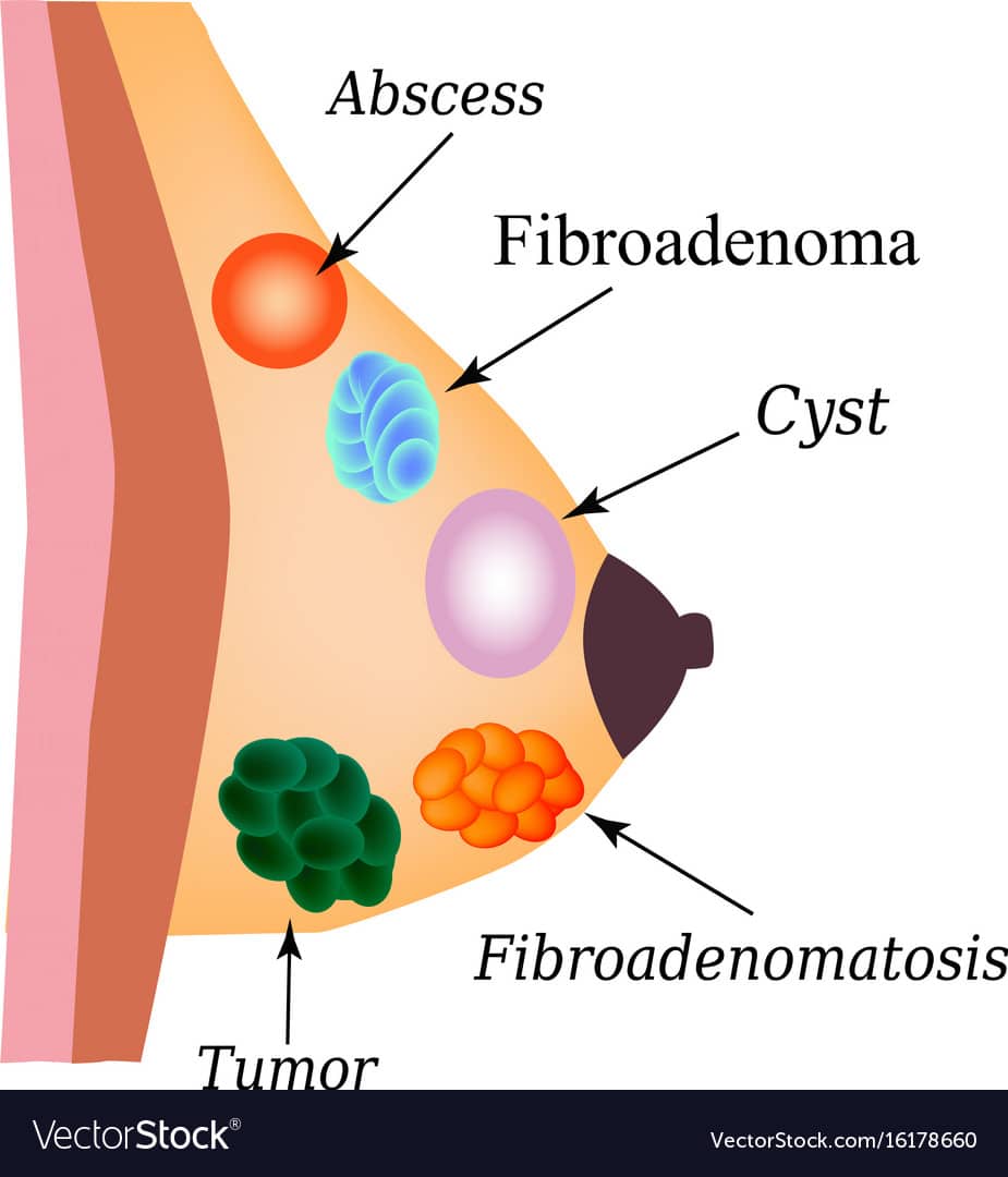 Fibroadenoma tumor cyst world breast cancer day Vector Image