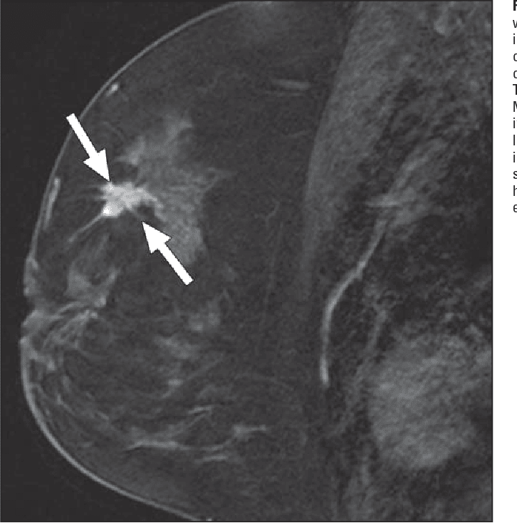 Figure 144 from MRI features of inflammatory breast cancer.