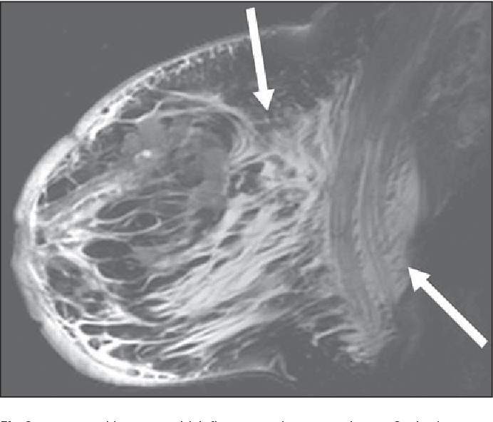 Figure 267 from MRI features of inflammatory breast cancer.