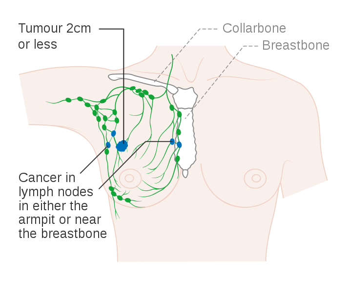 File:Diagram 1 of 2 showing stage 2A breast cancer CRUK ...