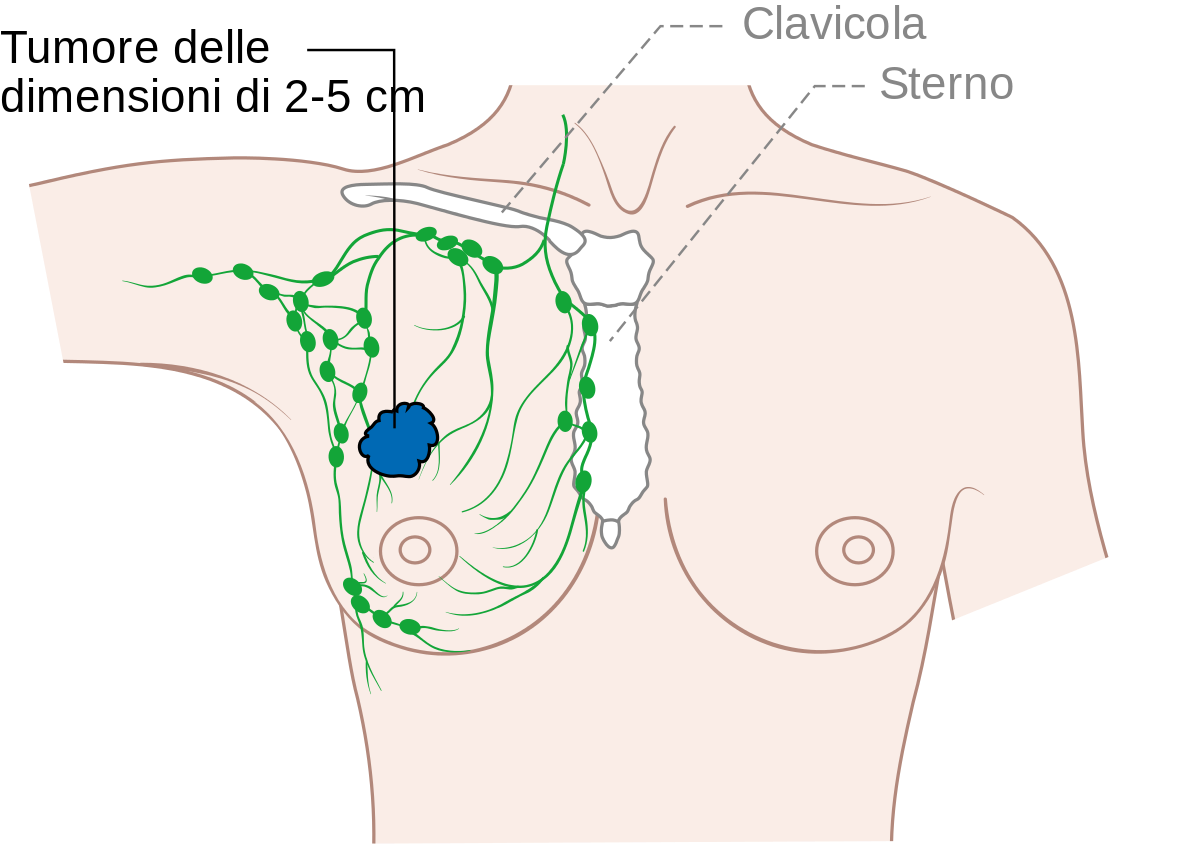File:Diagram 2 of 2 showing stage 2A breast cancer CRUK ...