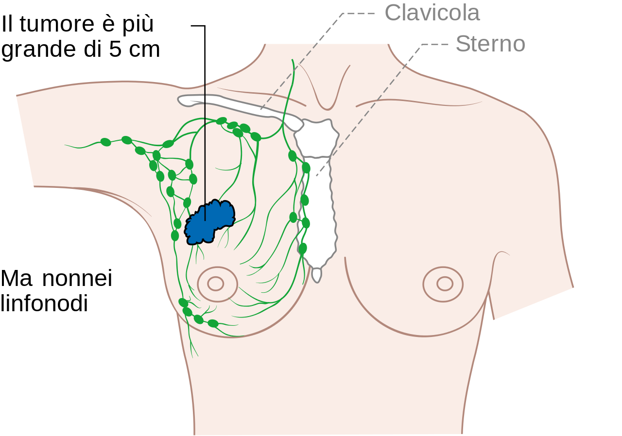 File:Diagram 3 of 3 showing stage 2B breast cancer CRUK ...