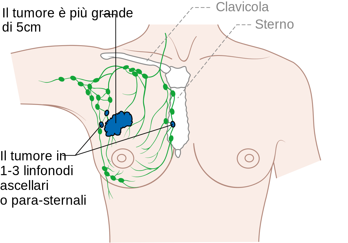 File:Diagram 3 of 3 showing stage 3A breast cancer CRUK ...