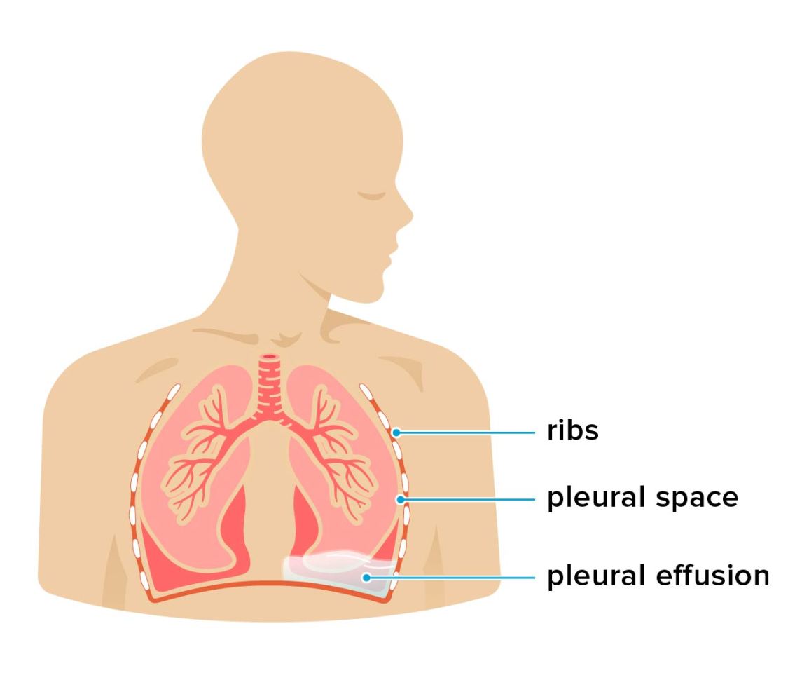Fluid in the Chest (Pleural Effusion)
