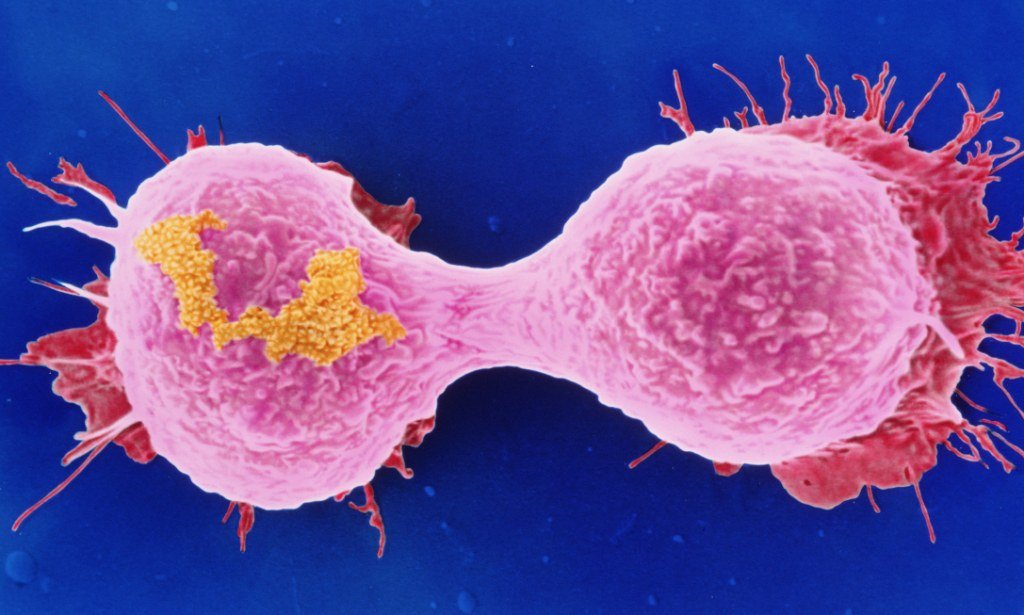 Gene that spreads breast cancer discovered paving the way ...