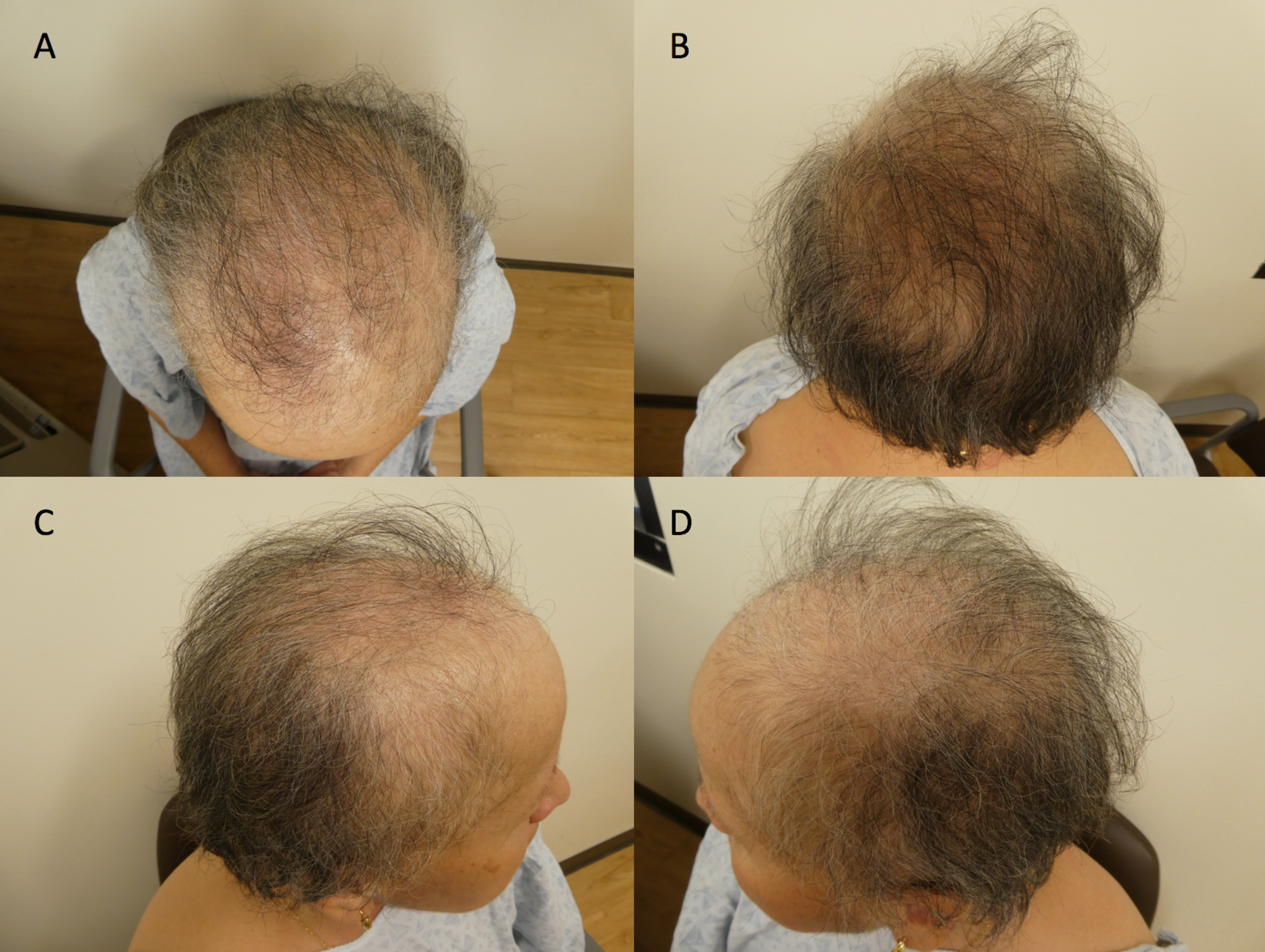 Hair Loss After Chemo
