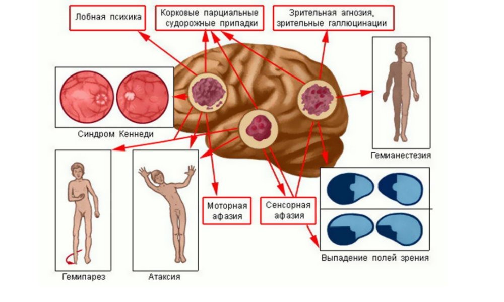 Headaches with brain cancer: causes, symptoms, treatment