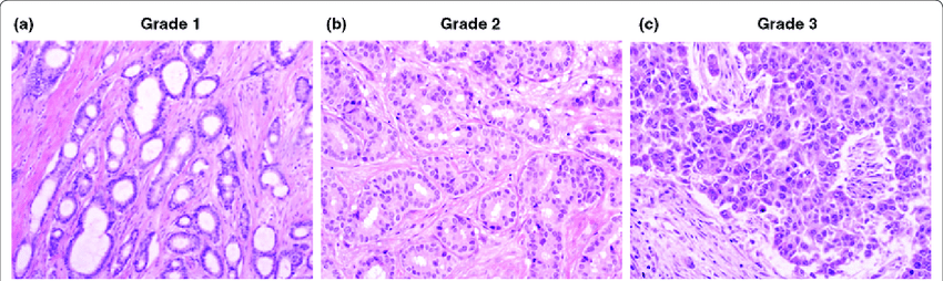 Histological grade of breast cancer as assessed by the ...