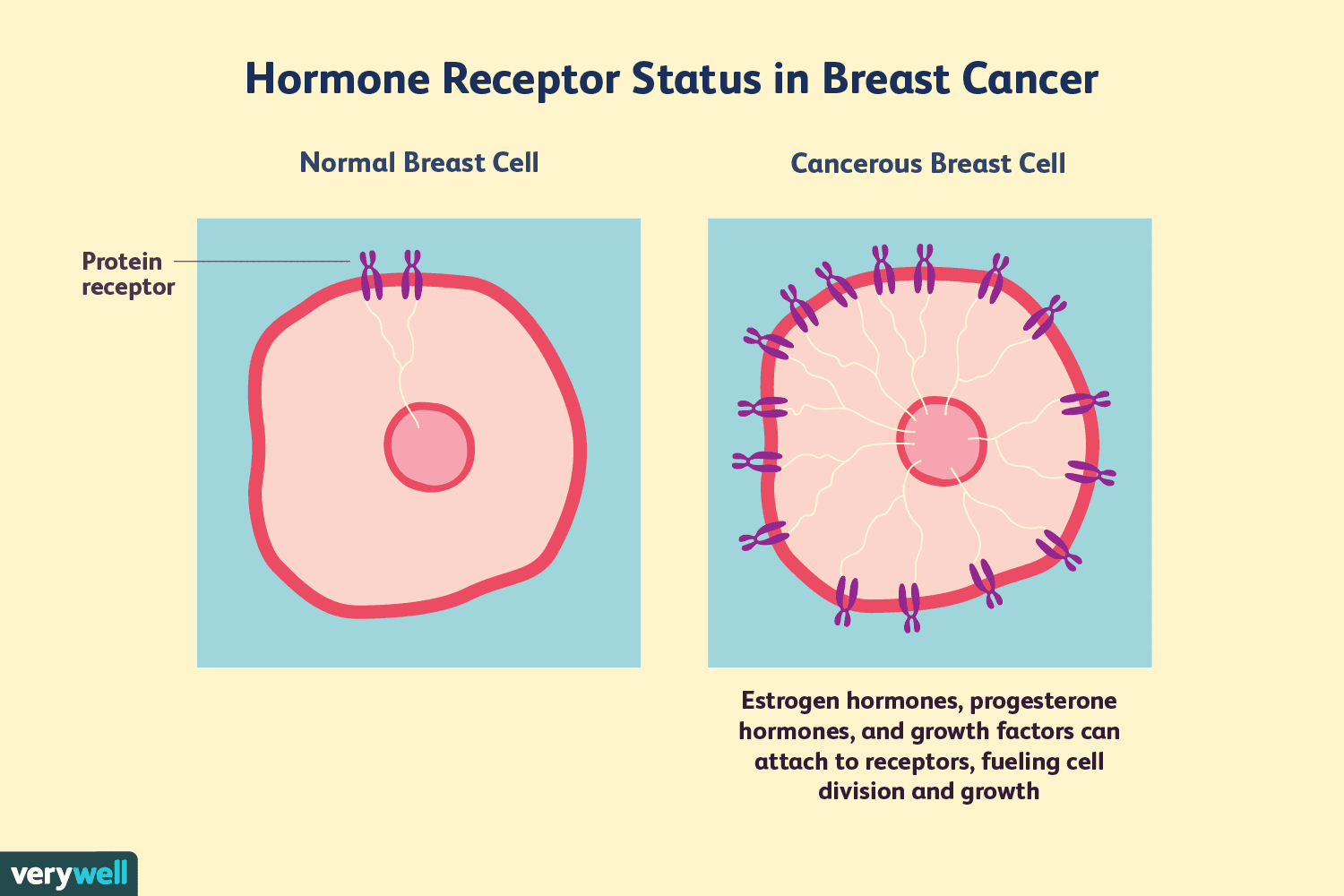 Hormone Receptor Status and Diagnosis in Breast Cancer