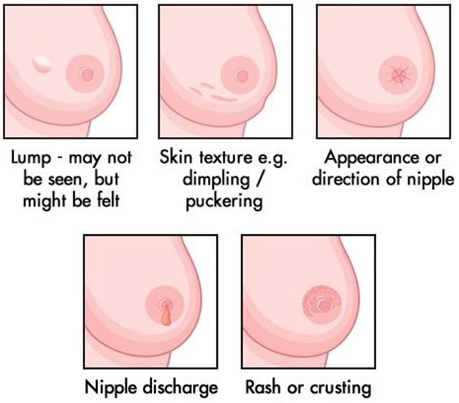 How do you know you have breast cancer?