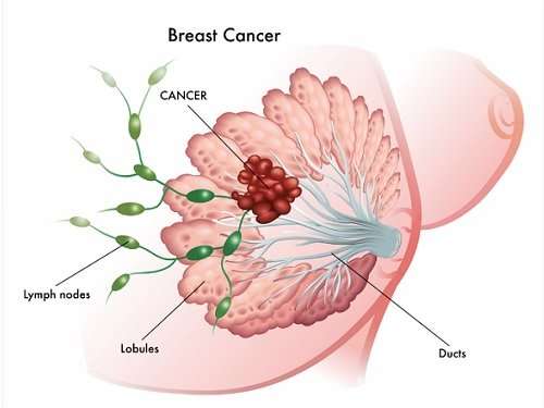 How Does Breast Cancer Form
