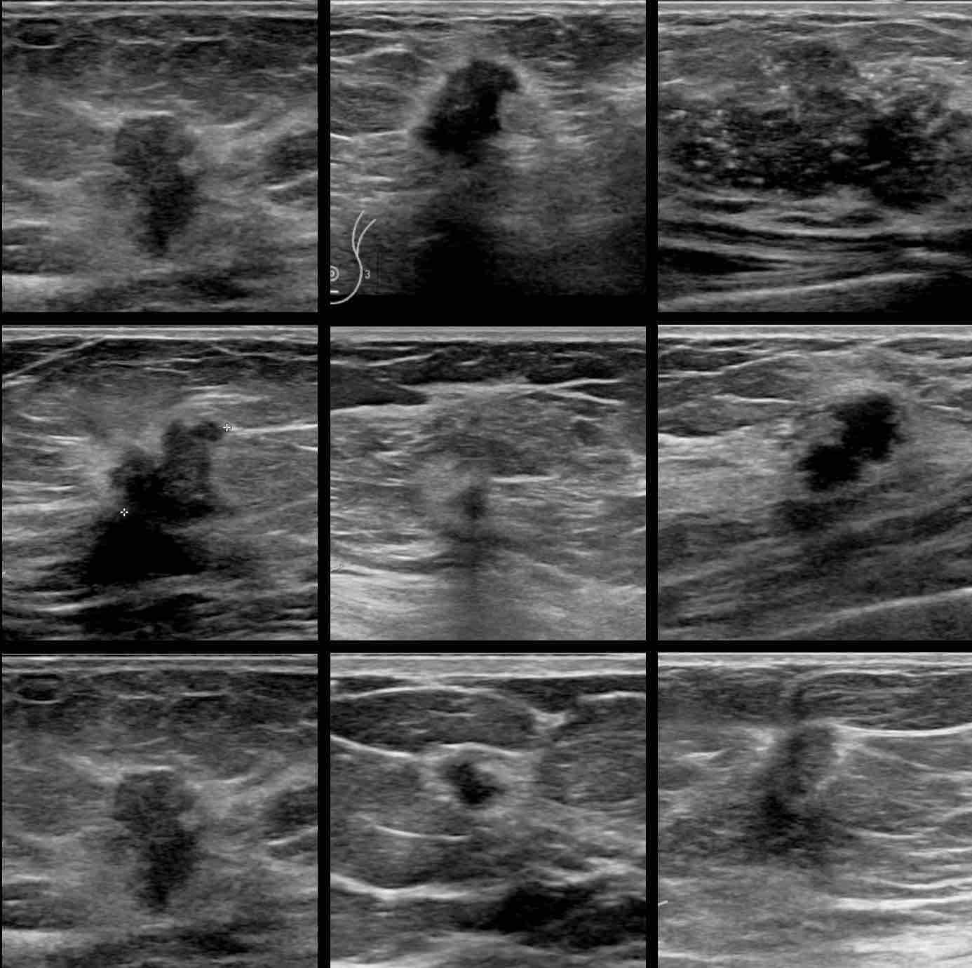 How Does Breast Cancer Look Like In Ultrasound