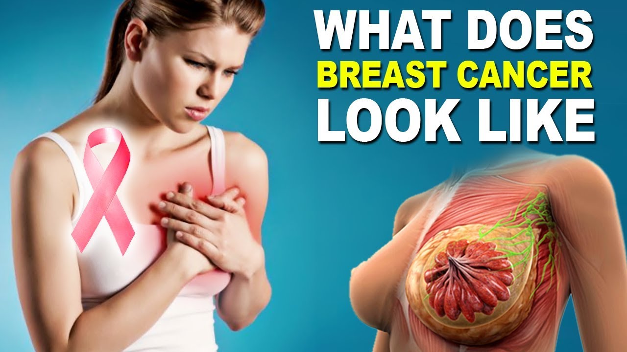 How Does Breast Cancer Looks Like