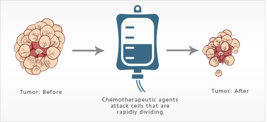 How does chemotherapy work