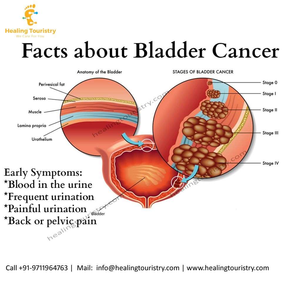 How Long Can You Live With Bladder Cancer Untreated ...