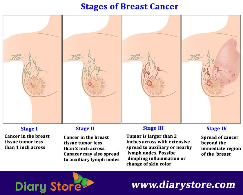 How many stages of breast cancer