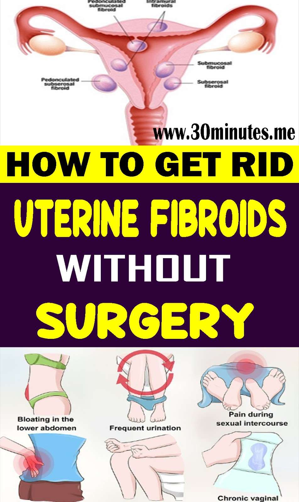 How to Get Rid of Uterine Fibroids without Surgery