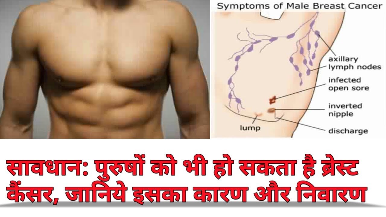 How To Know If You Have Breast Cancer Male