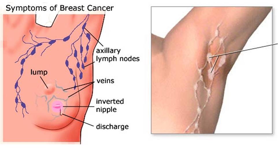 How to Prevent Breast Cancer Through An Armpit Detox ...