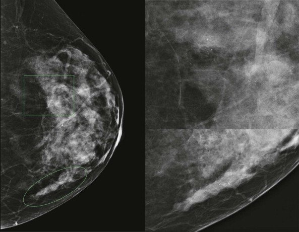 Imaging the Patient with Breast Cancer