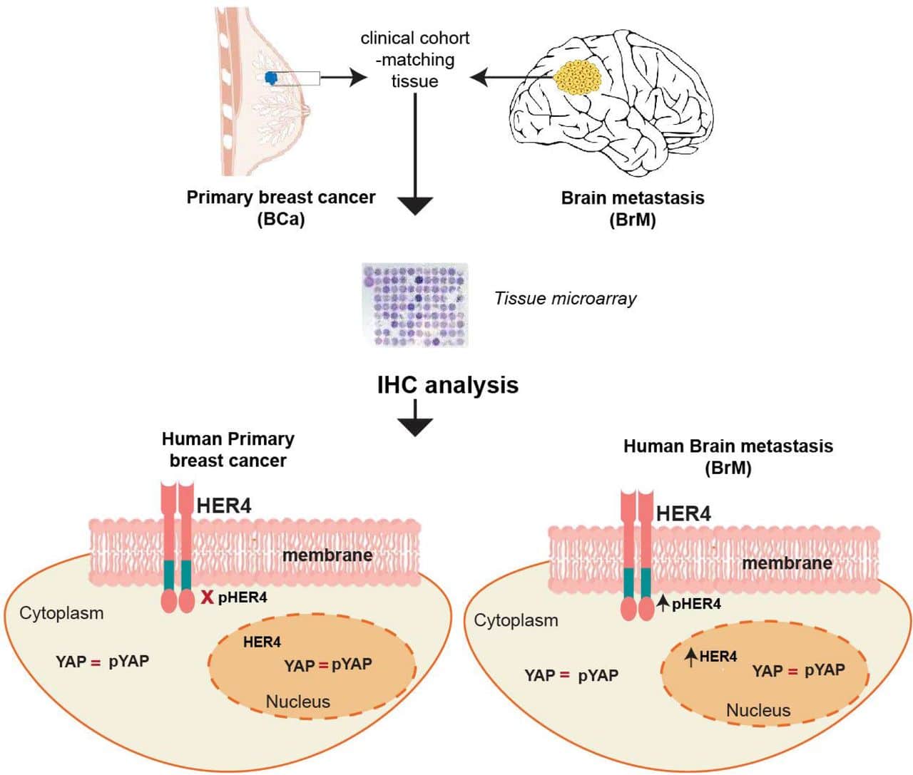 Immunophenotyping of HER4/YAP axis in breast cancer brain metastasis ...