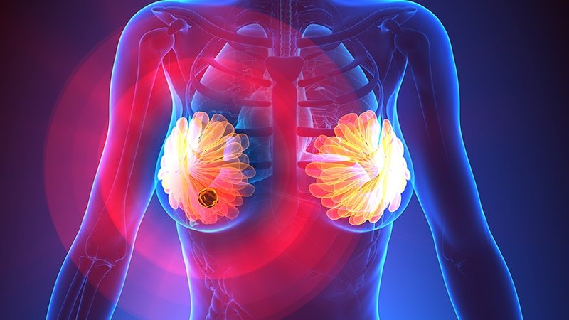 Immunotherapy Active in Early Stage Triple Negative Breast ...