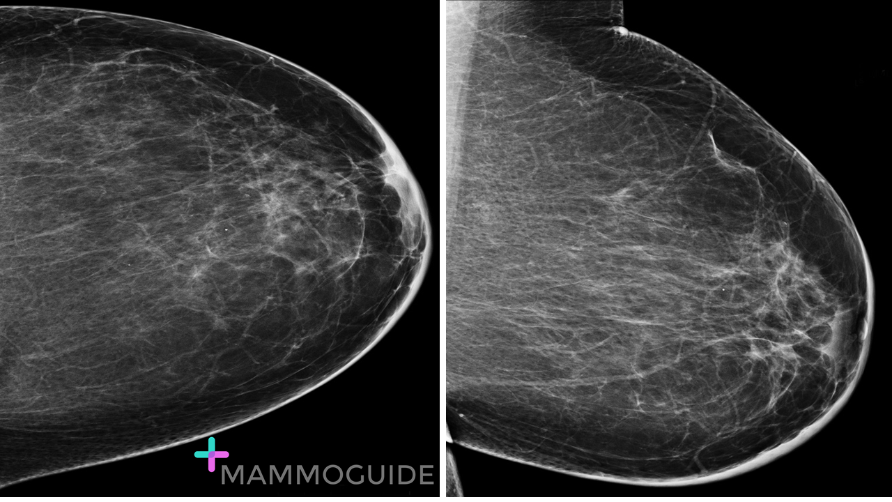 Inflammatory Breast Cancer on Mammography