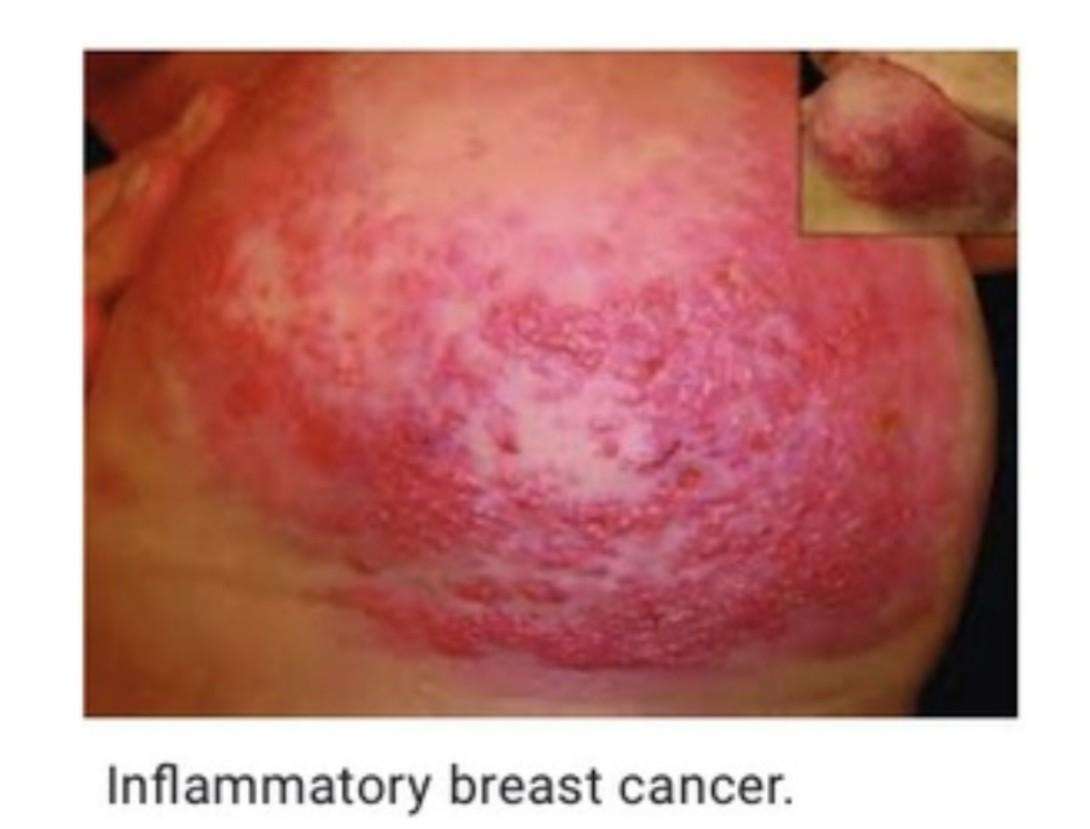 inflammatory breast cancer rash
