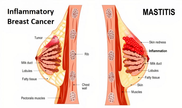 Inflammatory Breast Cancer