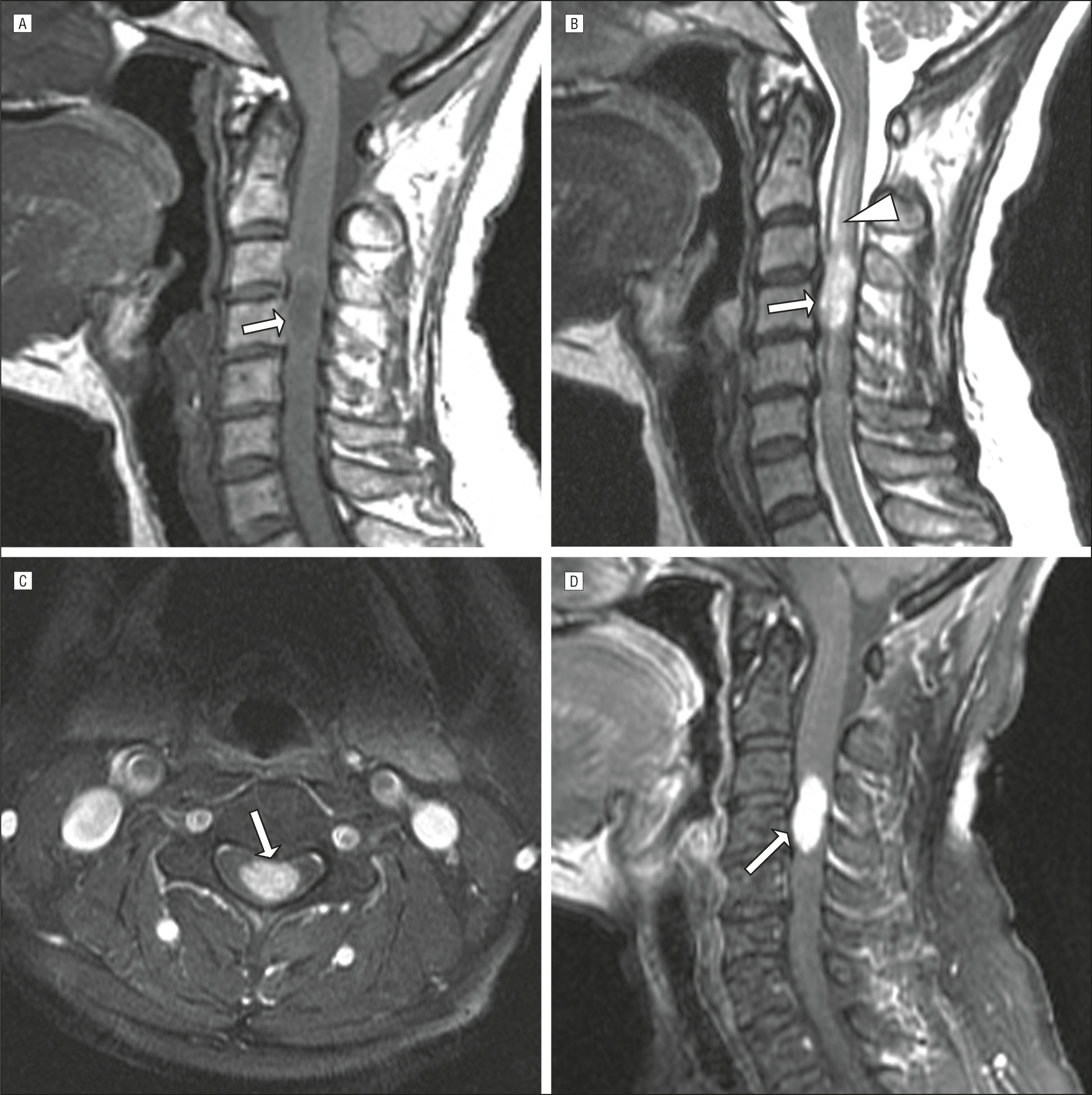 Intramedullary Spinal Metastasis From Breast Cancer