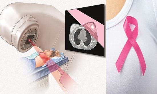 Intraoperative Radiation Therapy For Breast Cancer ...