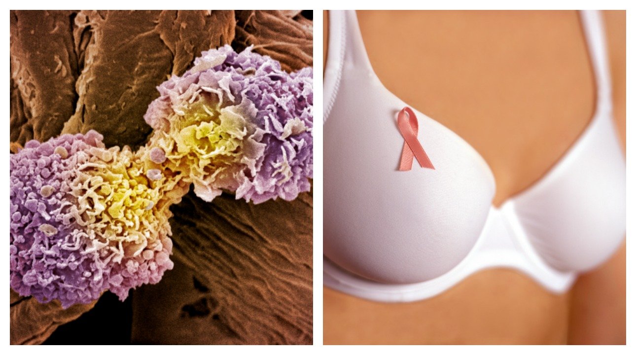 Is Breast Cancer Hereditary?