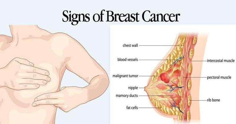 Knowing These Signs Of Breast Cancer Can Save Your Life