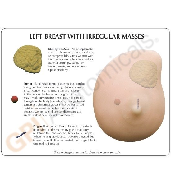 Left Breast Cancer Model, Life