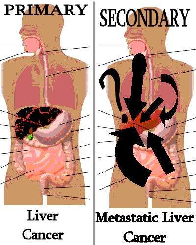 Liver Cancer: What Is Stage 4 Liver Cancer Life Expectancy