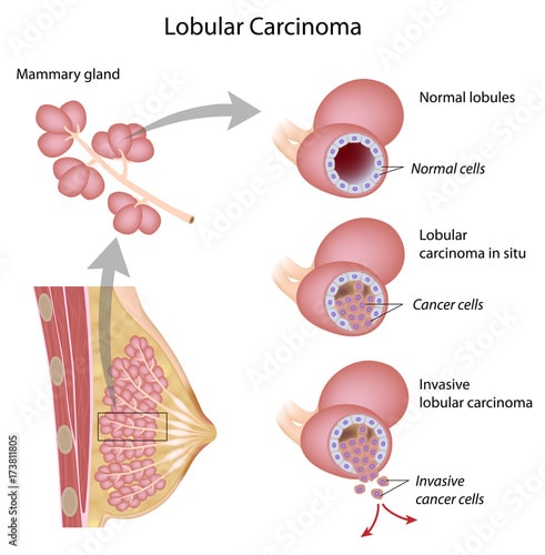 Lobular carcinoma breast cancer Stock Illustration