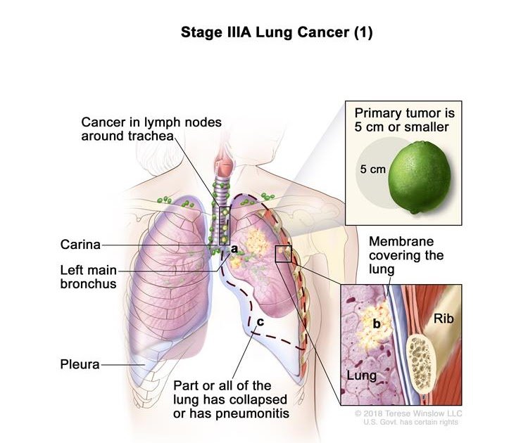 Lung cancer Metastasis To Liver