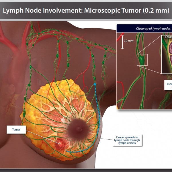 Lymph Node Involvement: Microscopic Tumor (0.2 mm)