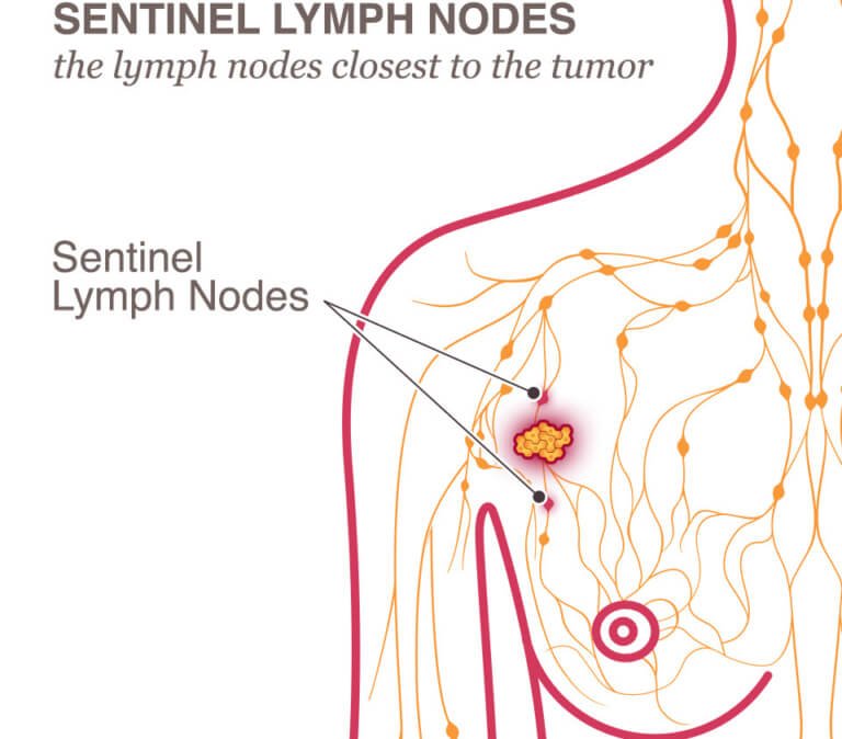 Lymph Node Removal & Lymphedema
