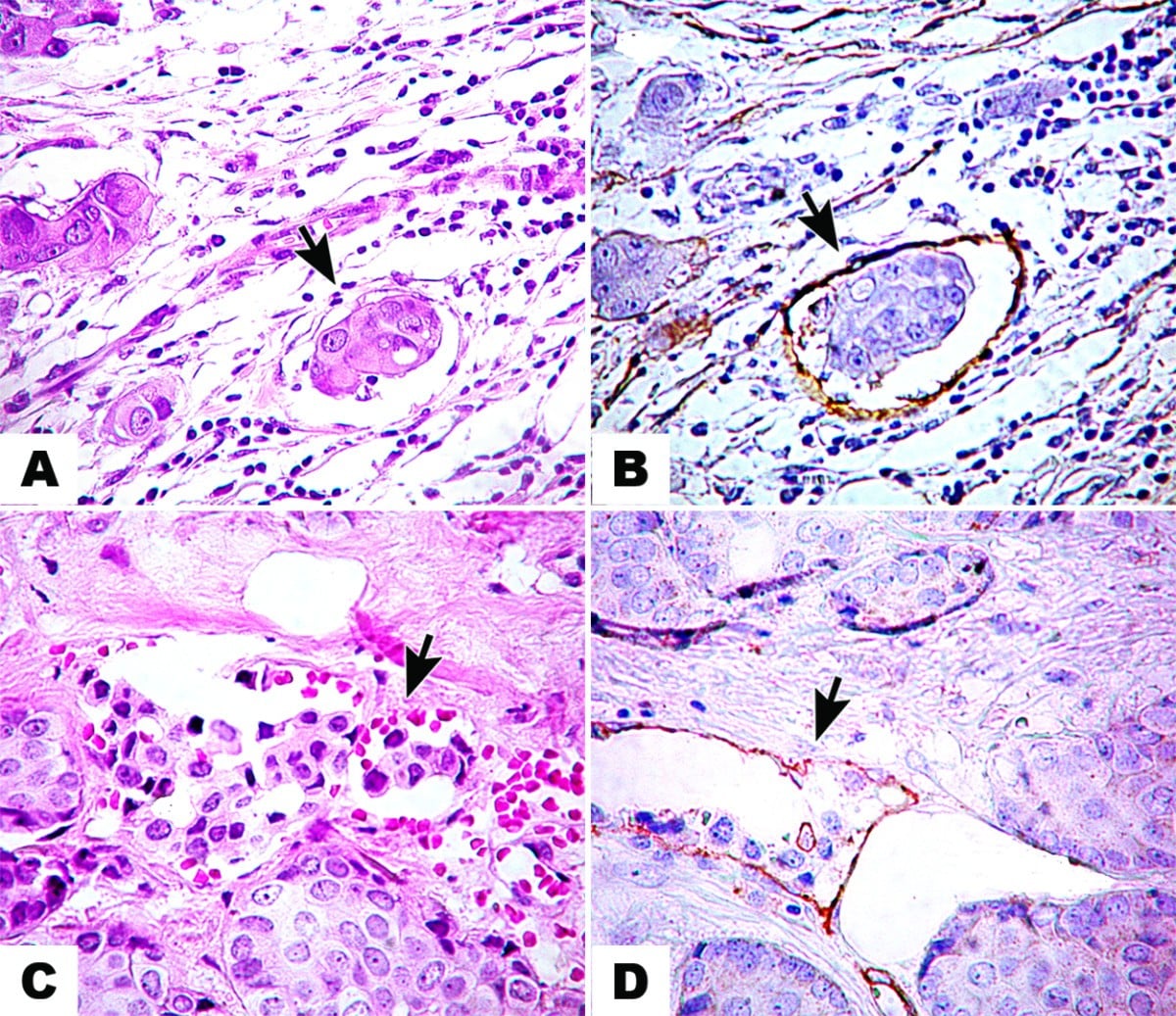 Lymph vascular invasion in invasive mammary carcinomas identified by ...