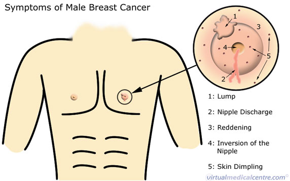 Male breast cancer signs