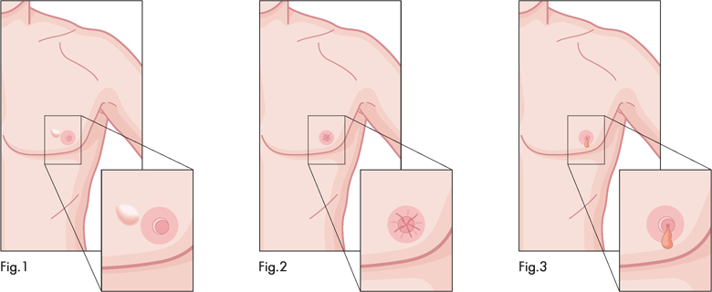 Male Breast Cancer Signs, Symptoms, Treatment