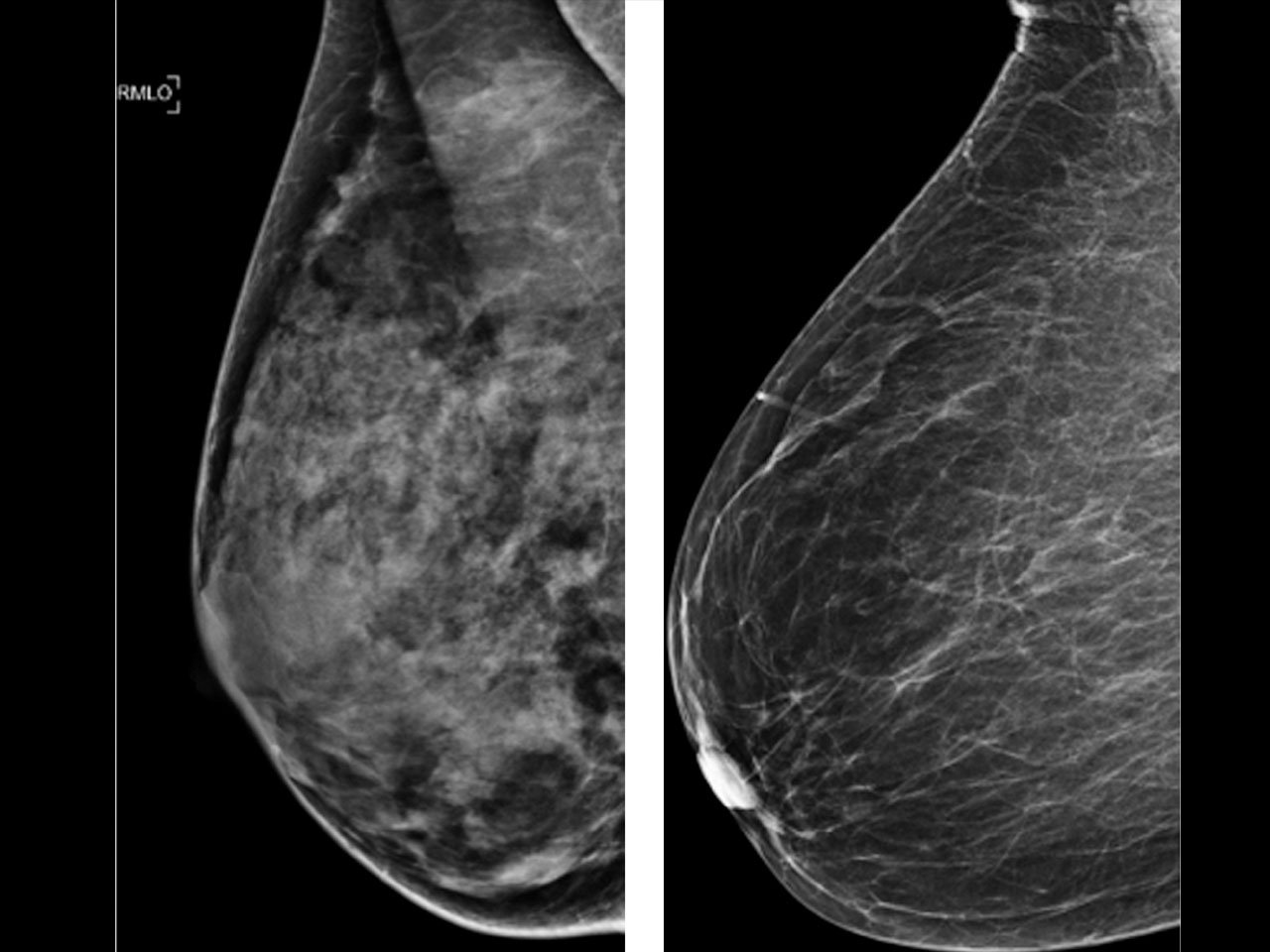 Mammogram study: Dense breasts won