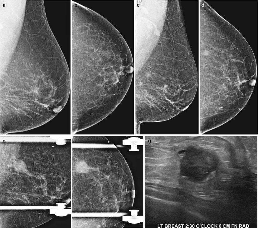 Mammographic Signs of Breast Cancer